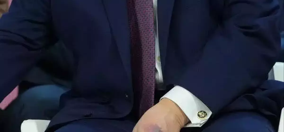 Trump Explains Hand Bruise Amid Health Speculation