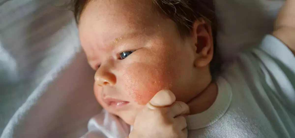 Common Rashes in Children: Identification and Management