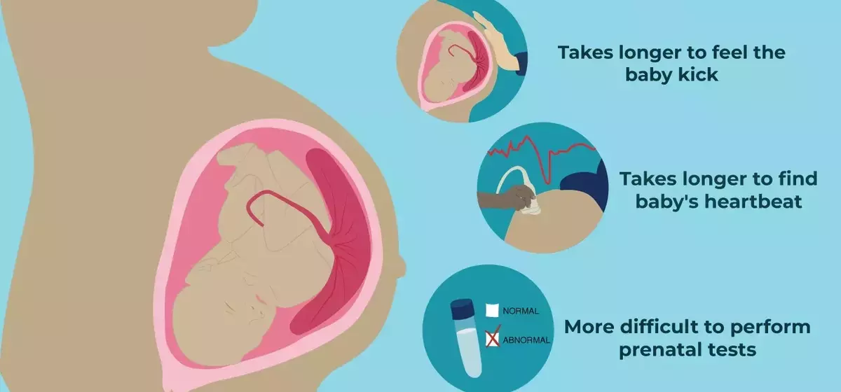 Understanding Anterior Placenta During Pregnancy