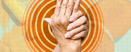 Dietary Strategies to Mitigate Arthritis Flare-Ups