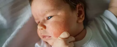 Common Rashes in Children: Identification and Management