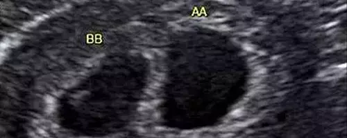 A Journey Through Twin Pregnancy: Ultrasound Milestones