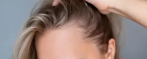 Veradermics: Pioneer in Pattern Hair Loss Treatment with Promising Oral Minoxidil